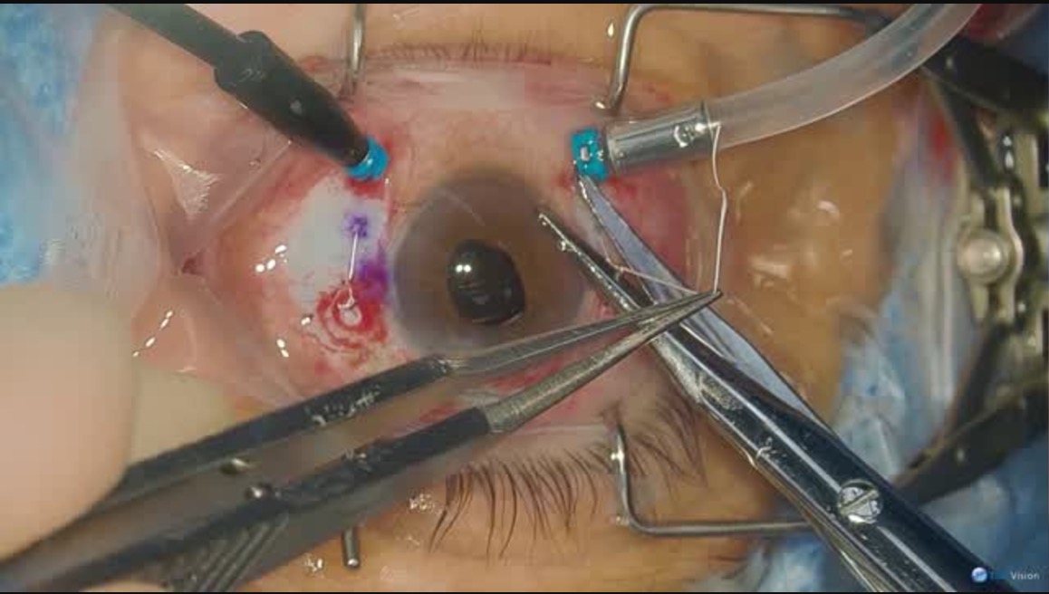 4-Point IOL Fixation