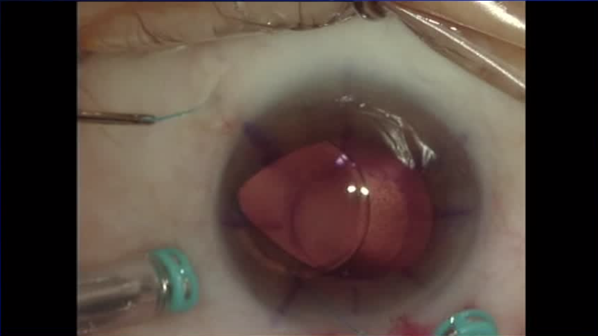 Subluxated IOL