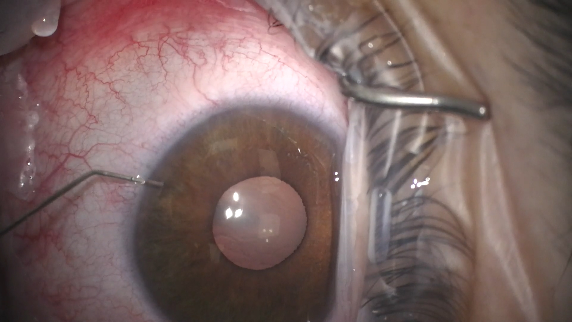 GATT for Persistent IOP Elevation