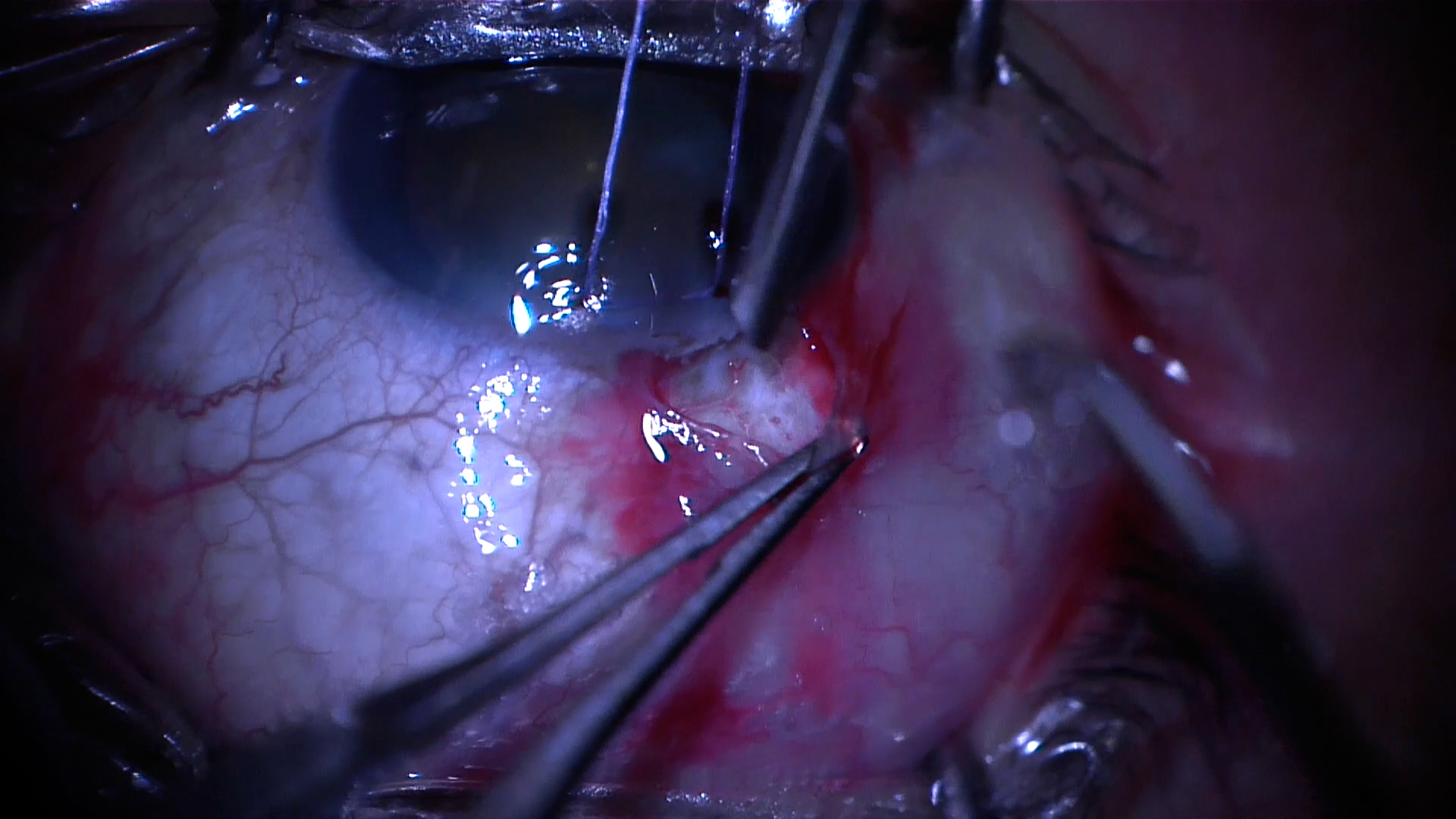 Showcasing Two Surgical Techniques