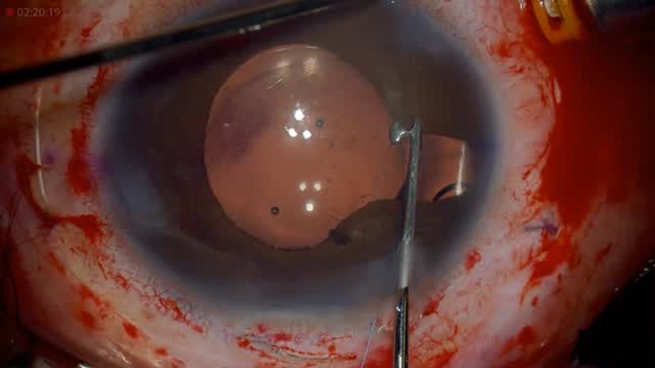 Bridging the Gap: An Added Dimension to Coloboma Repair