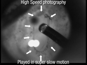 Tackling the Vitreous