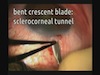 Small Incision Trabeculectomy