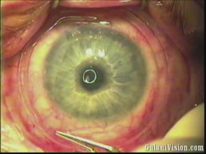 Corneal Scar