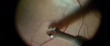 The Best Way to Peel the ILM