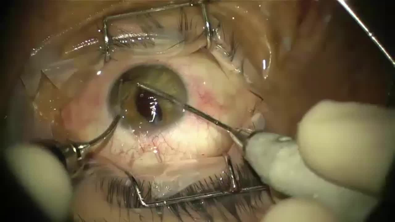 Management of Dislocated Posterior Chamber IOL