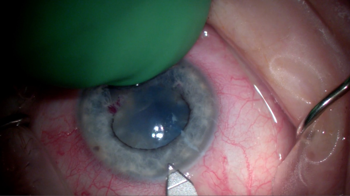 miLOOP Training: Nasal Two-handed Technique with Can Opener Rhexis on Patient with Floppy Iris