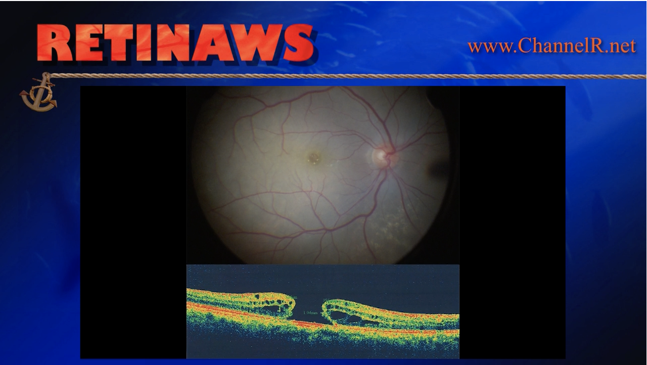 Macular Surgery