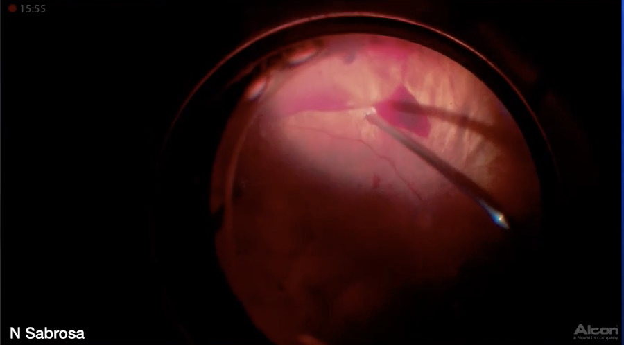 Peribulbar Anesthesia