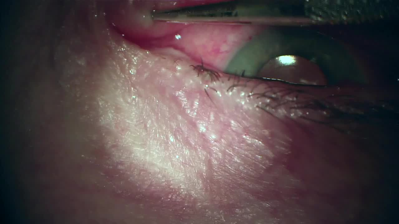 Dextenza Angle and Punctal Dilation