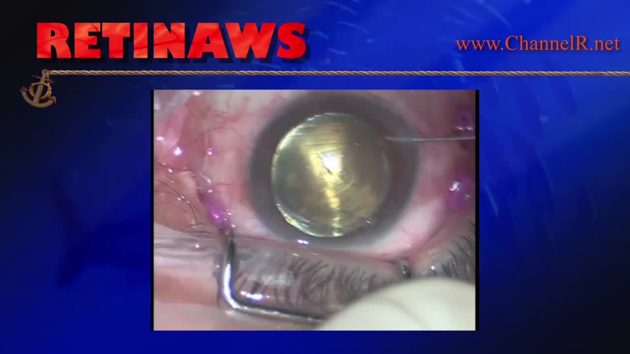 Air in Anterior Chamber