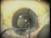 Enhancement For Residual Astigmatism Following Toric IOL Implantation