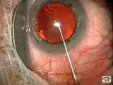 The Needle Capsulorhexis Technique