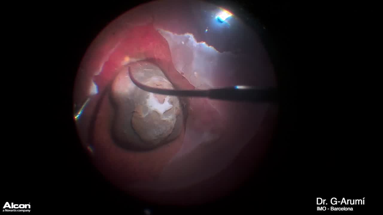 Melanoma