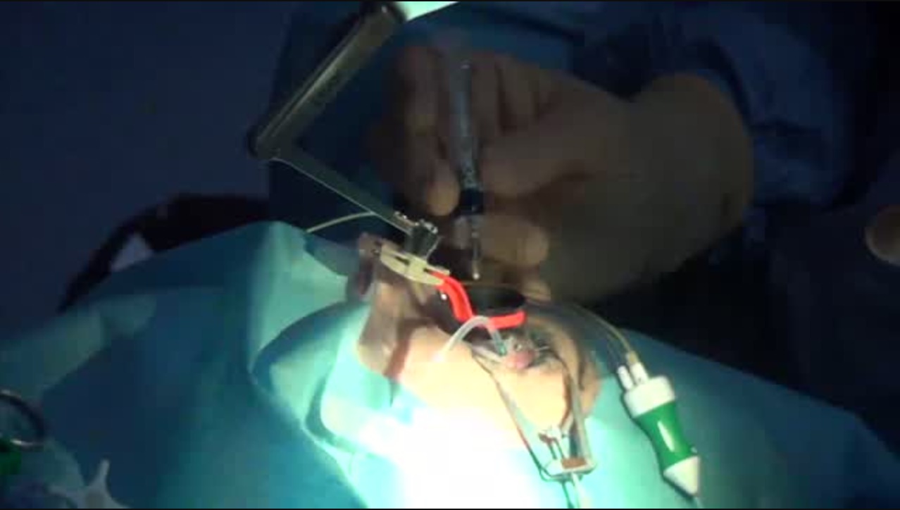 Myopic Macular Schisis and Cataract [FLOREtina Live Surgery]