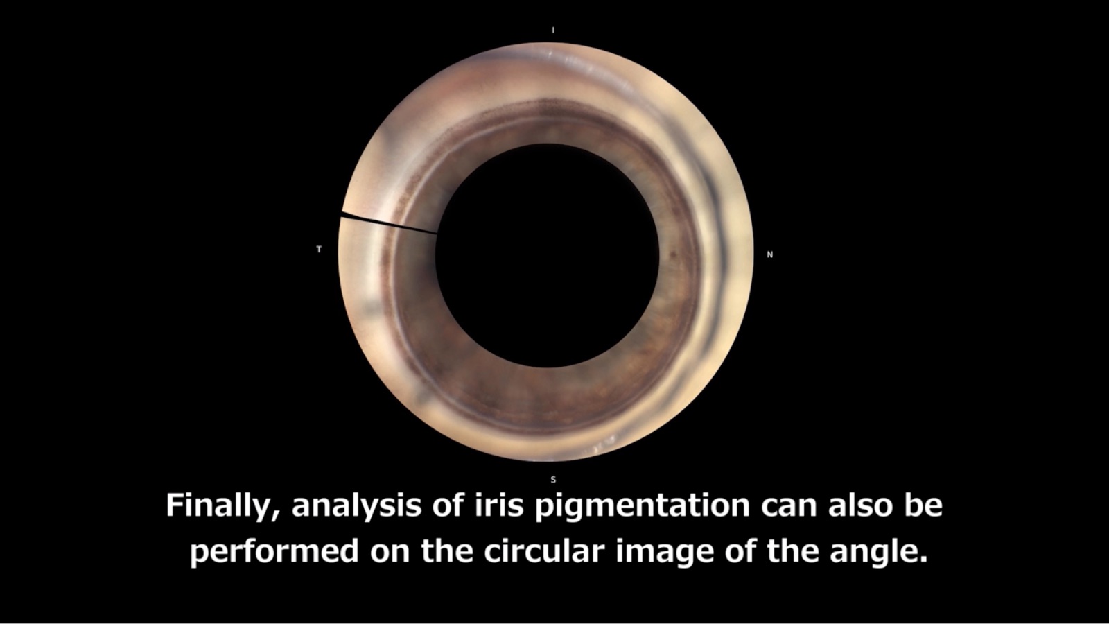 Automated Gonioscopy - A New Iridocorneal Angle Imaging Technique