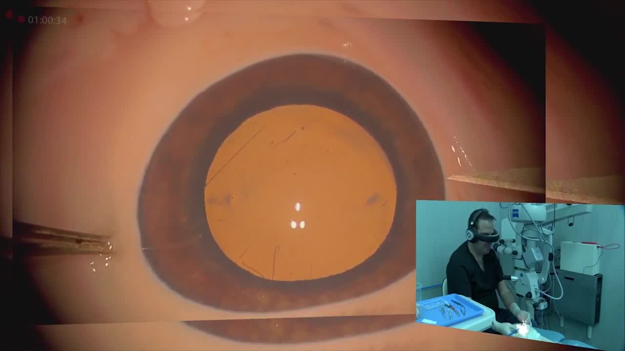 Virtual 3D Retinal Projection as Mixed Reality Cataract Surgery in Human Eye