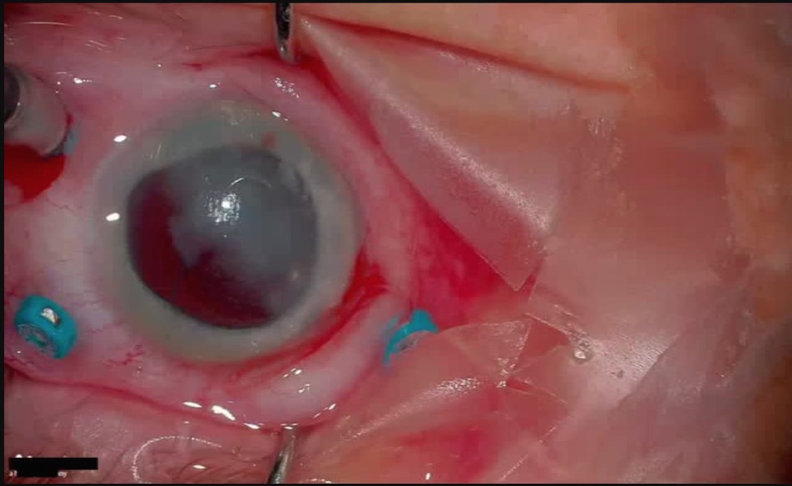 Retained Lens Fragments and Hemorrhages