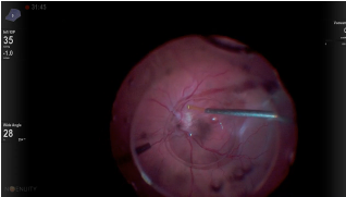 Crazy Macular Fold Repair
