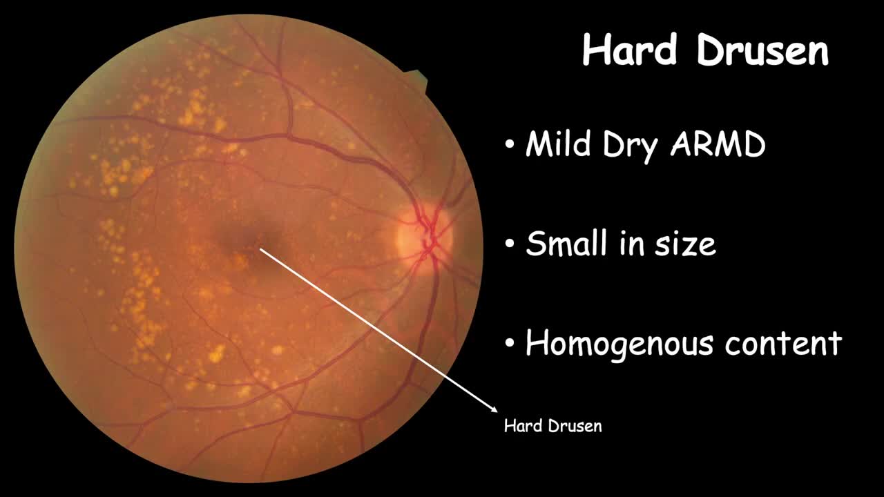Clinical Changes in RPE: Drusen 