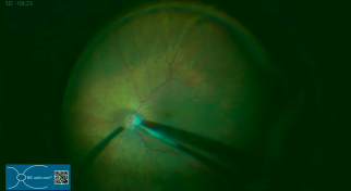 Phaco and Macular Peeling