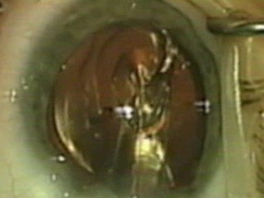 Pediatric Sulcoflex Duet-Implantation