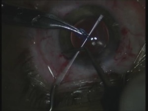 AssiAnchor for Dislocated LenS or IOL-bag Complex 