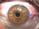 Using the Terry-Schanzlin Astigmatome (Case 1)