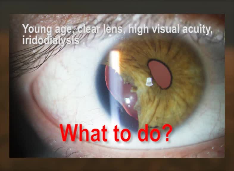 Fixing the Consequences from Blunt Trauma in a Phakic Eye