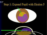 Use of Healon 5 in Floppy Iris Syndrome