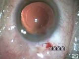 The Snowman Technique for IOL Implantation