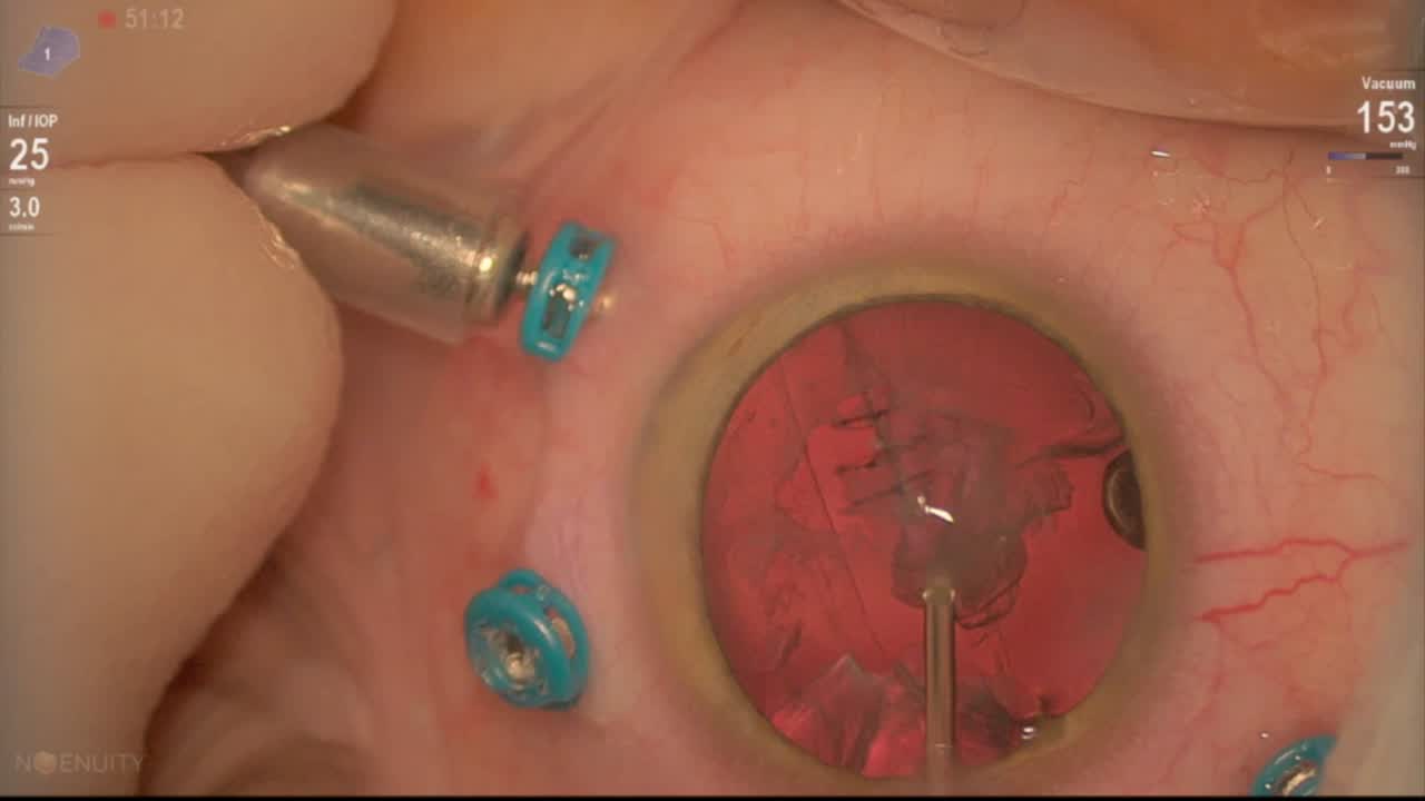 Intralenticular Foreign Body Removal