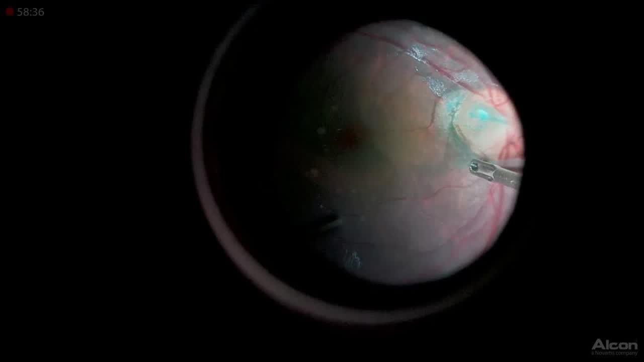 Optic Nerve Pit