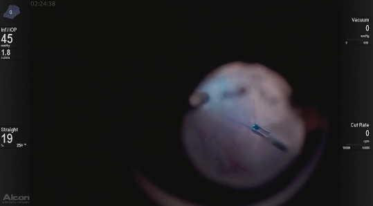25-Gauge DSP ILM Forceps for a Pseudophakic Patient With VMT