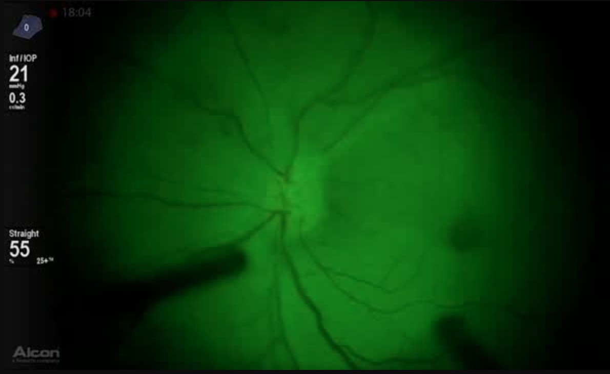 Surgery for BRVO on a 3D Platform