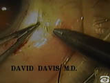 Pars plana vitreous aspiration