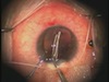 Traumatic Cataract with Vitreous Prolapse
