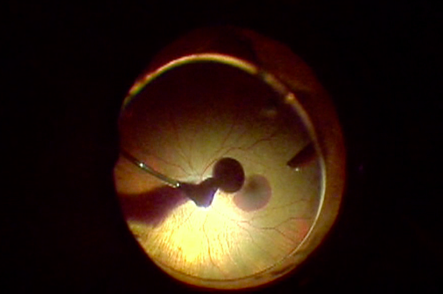 Iatrogenic Macular Hole After TPA Injection for Submacular Hemorrhage
