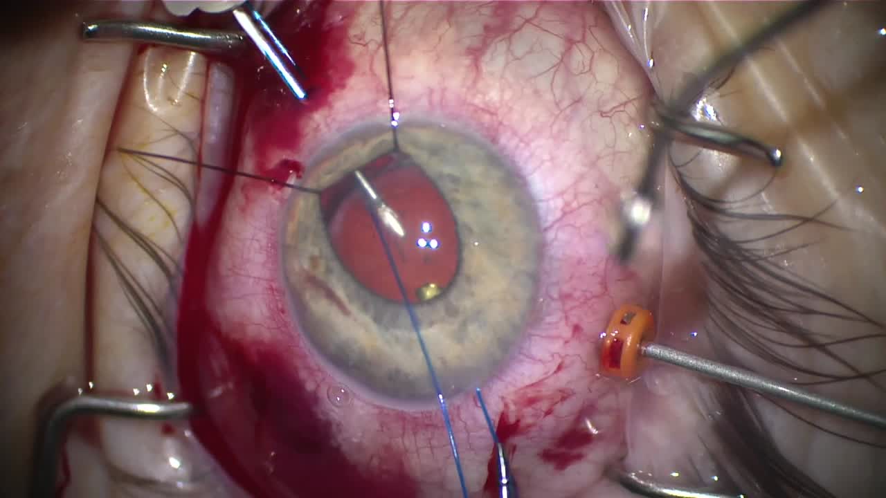  Snaring a Dislocated IOL with 5-0 Prolene Sutures