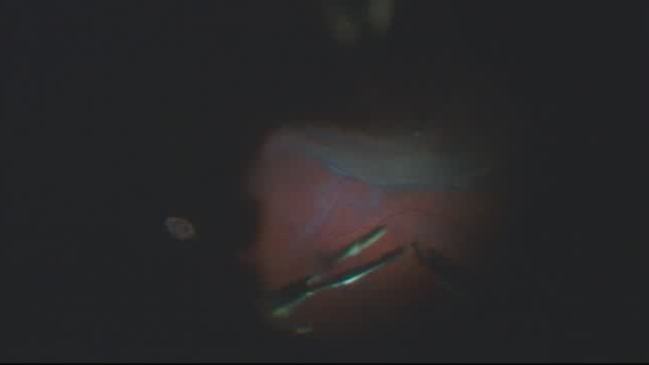 Recurrent Retinal Detachment Under Silicone Oil [FLOREtina Live Surgery]