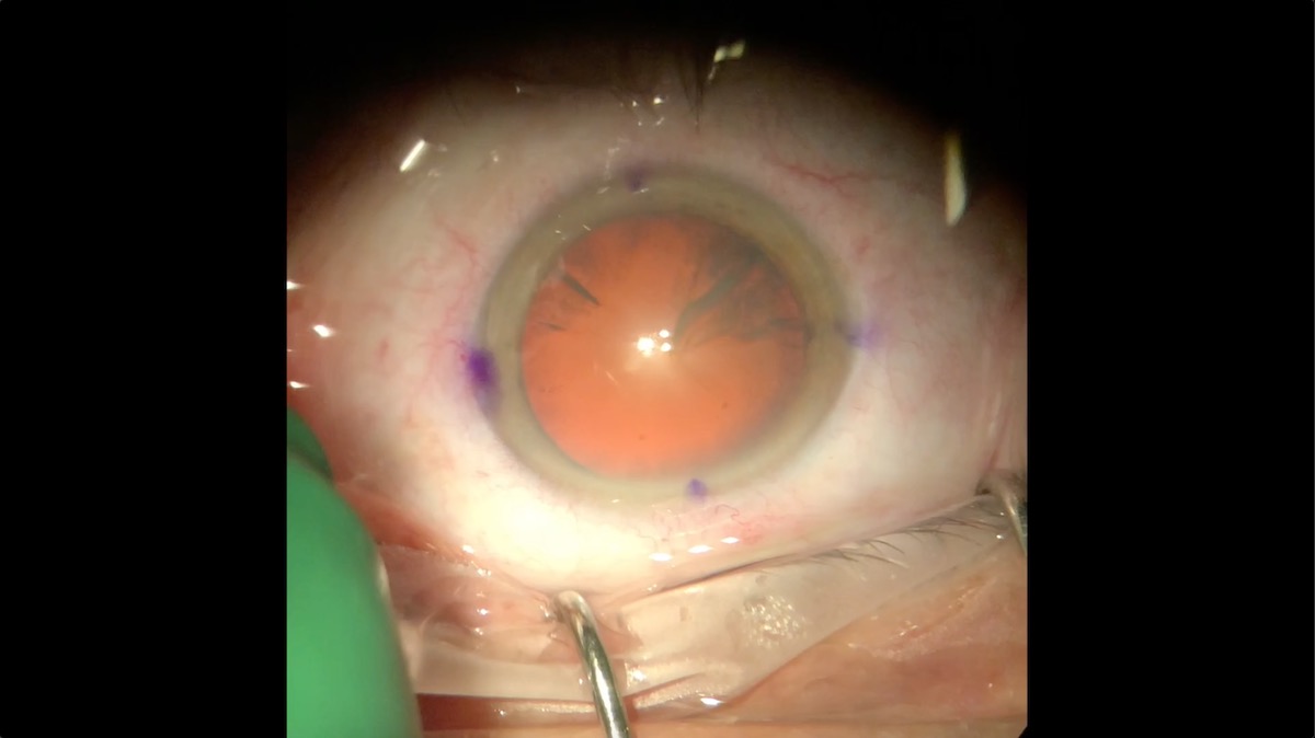 miLOOP Training: Temporal Two-handed Technique on Patient with Marfans Syndrome with Prior LASIK Surgery