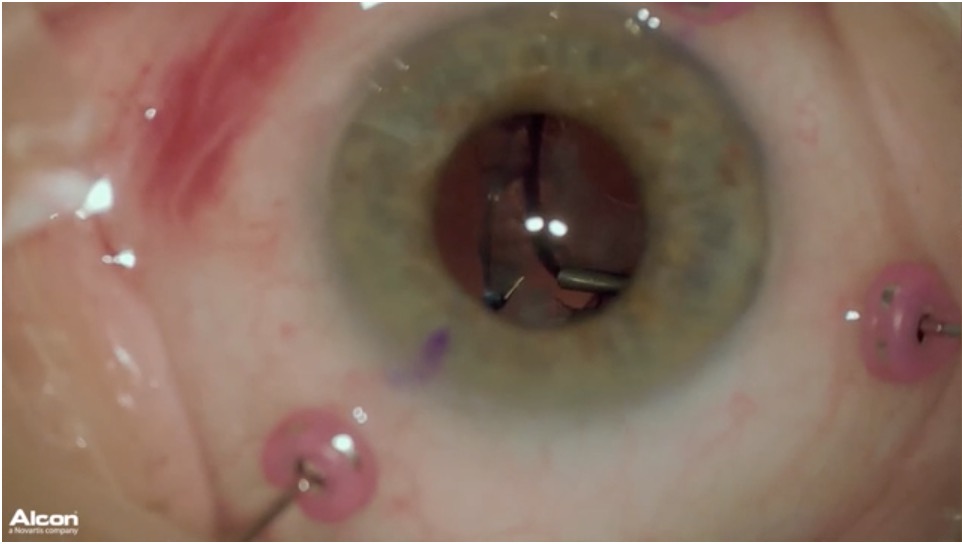 27-Gauge Transconjunctival Sutureless 3-Port Cannula Based Scleral Fixation of 3-Piece IOL