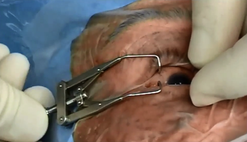 Ong Eye Speculum