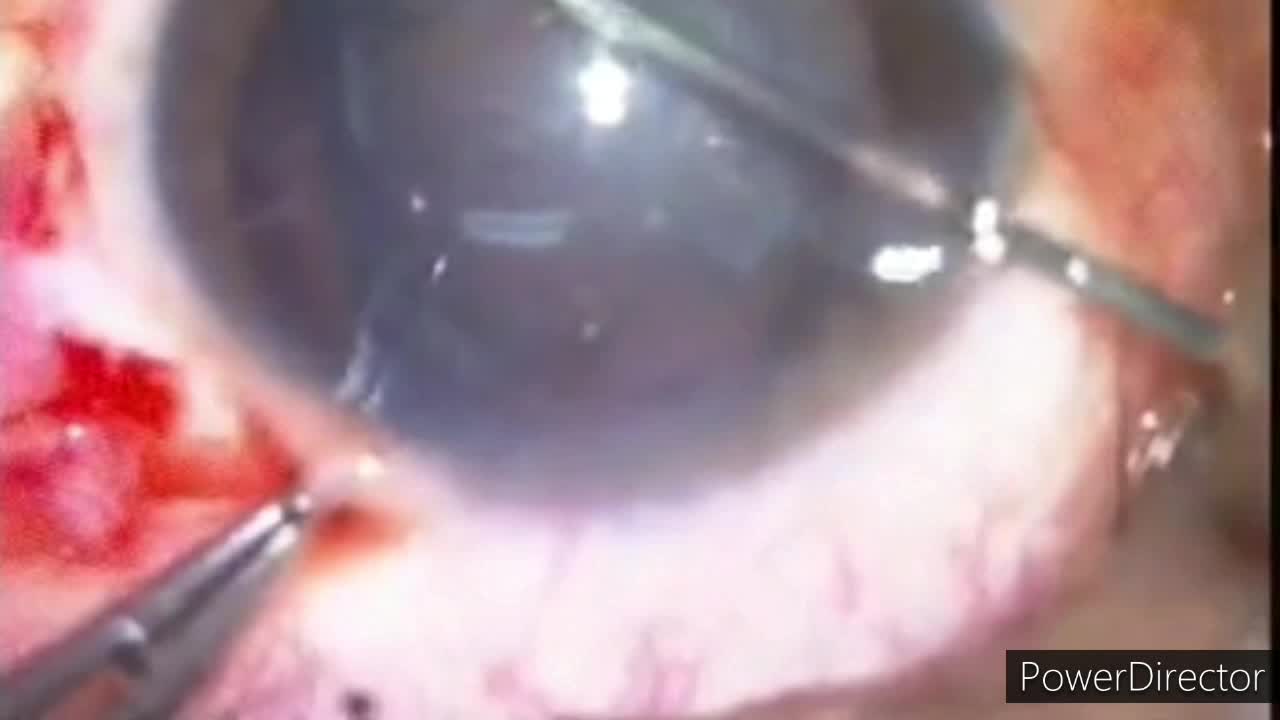 Traumatic Cataract: A Complex Case