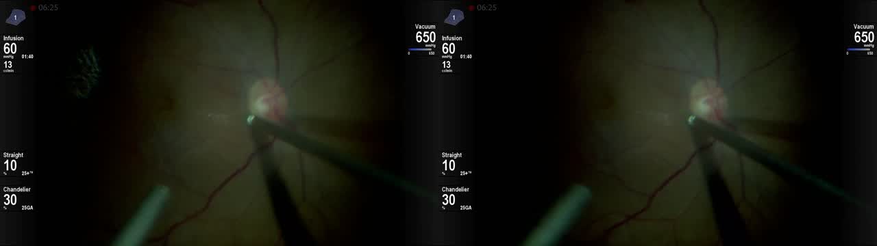 Alcon's DataFusion Software and Beveled Tip Probe (3D)