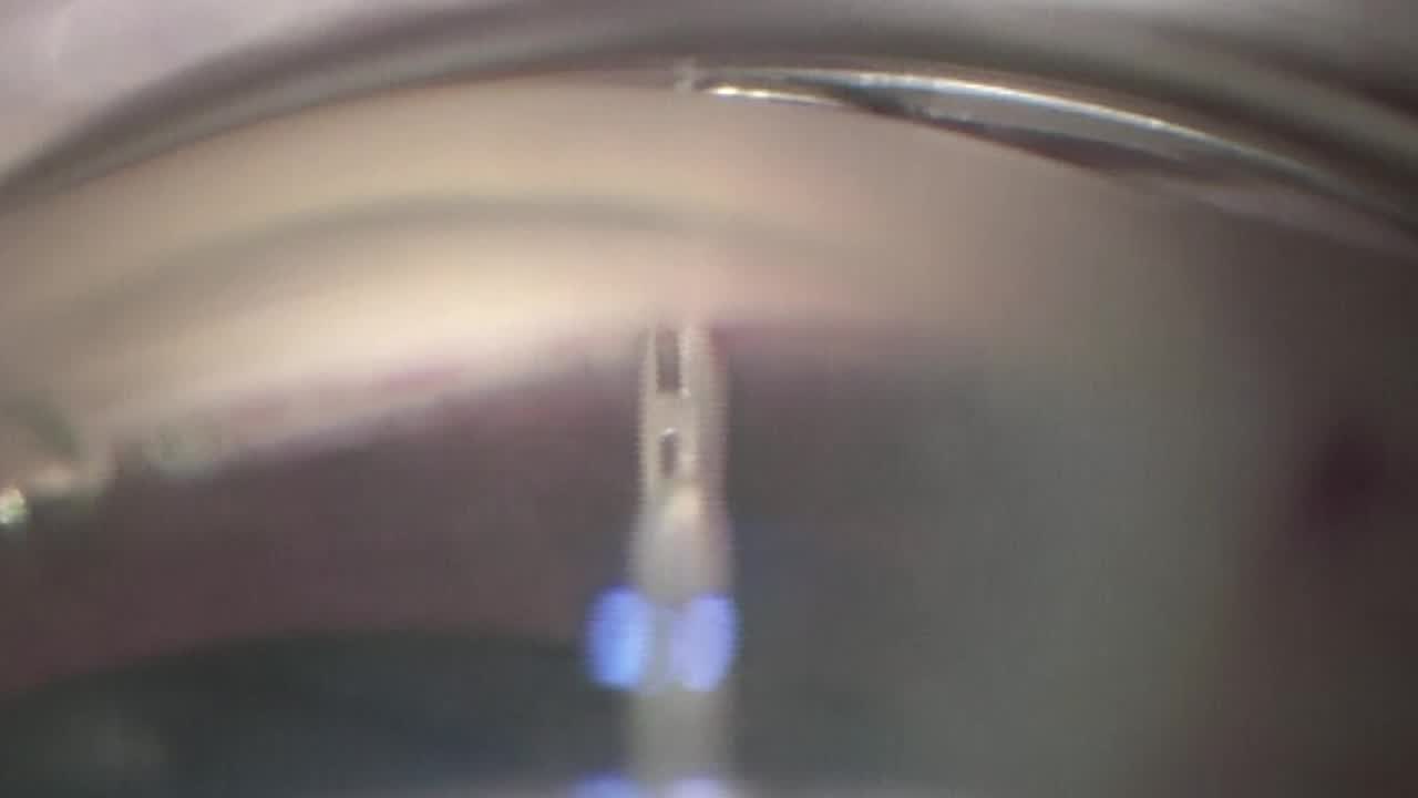 Visualizing the Trocar