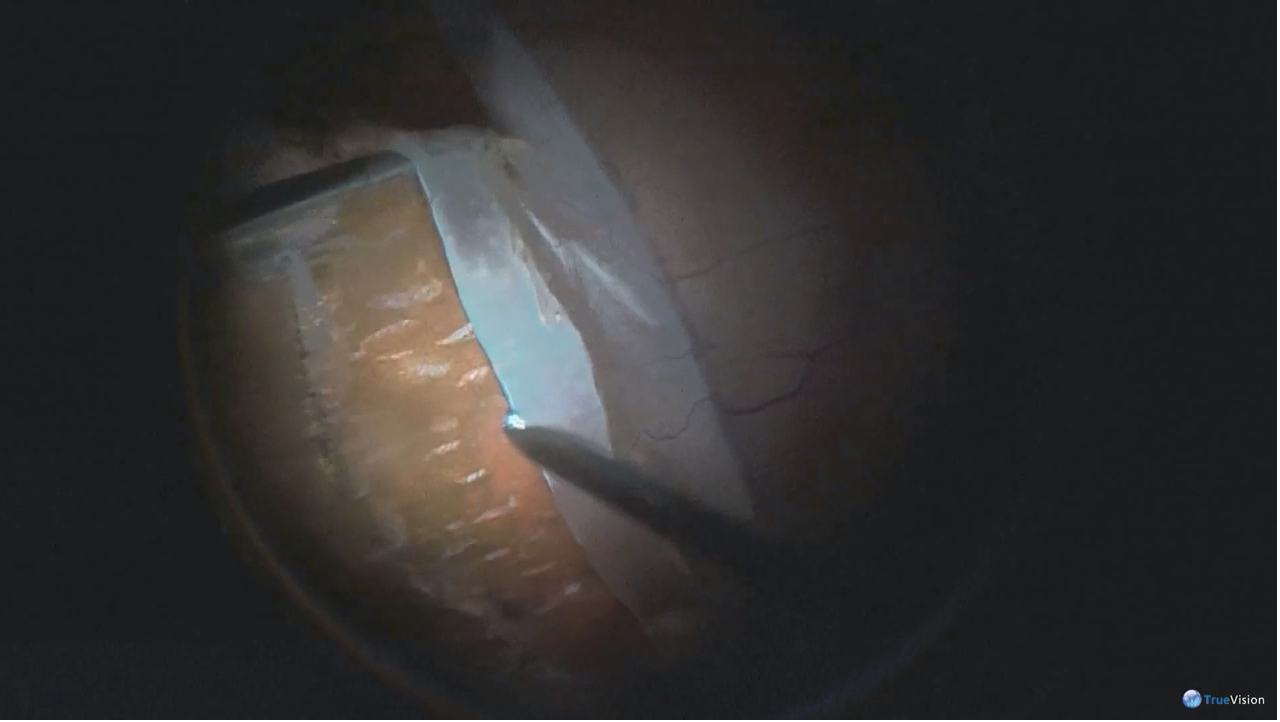 Retinal Fold