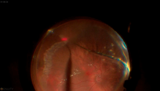 Retinal Detachment With Giant Retinal Tear