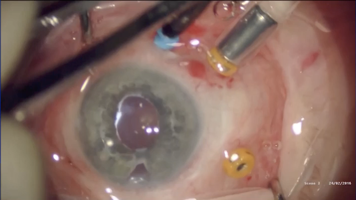Intruded Scleral Buckle