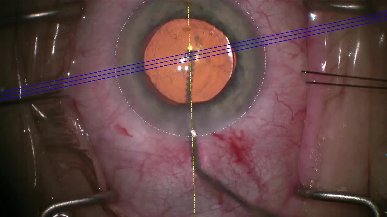 Callisto Centration of a Repositioned ActiveFocus Toric IOL